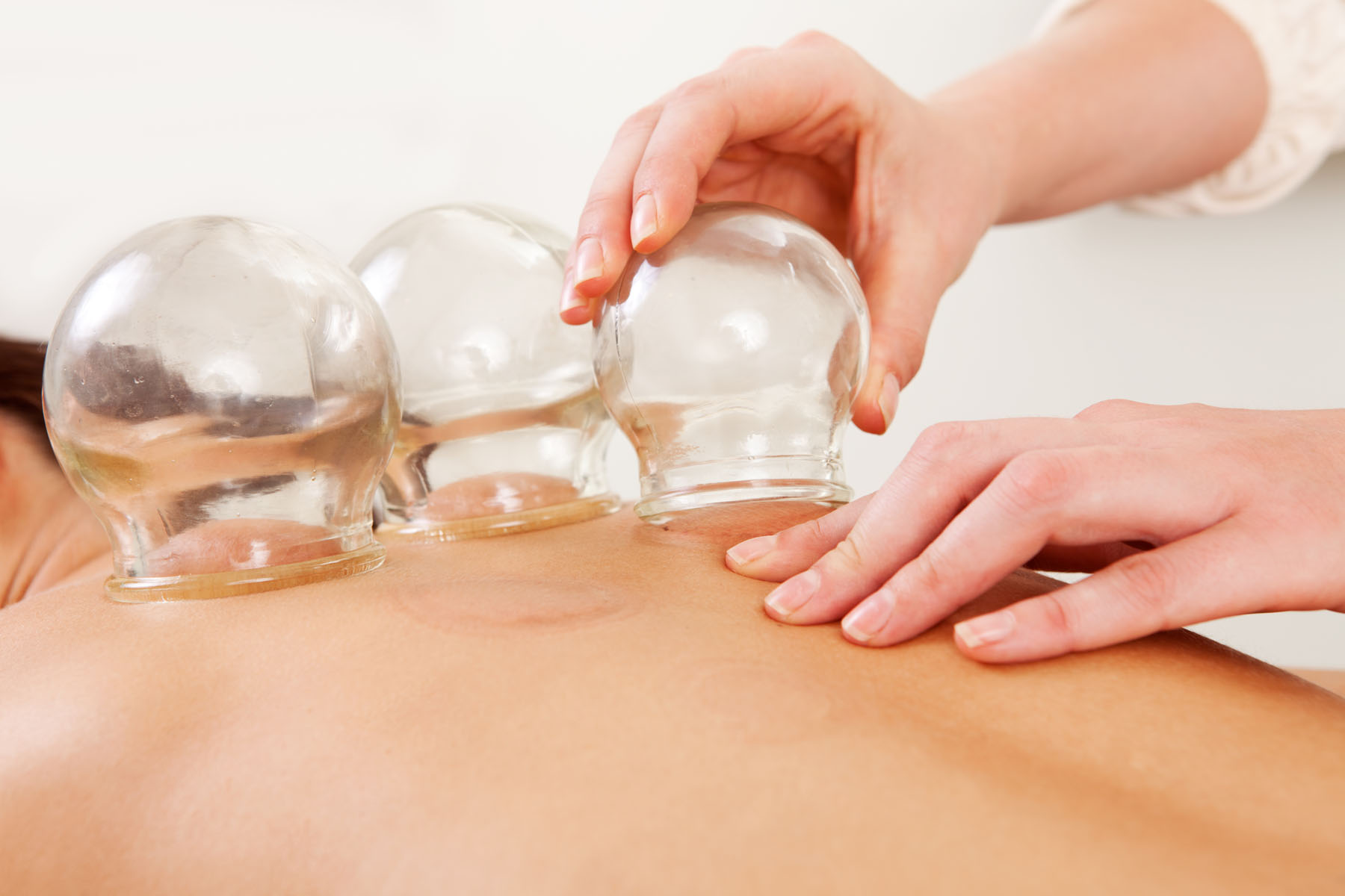Cupping acupuncture therapy